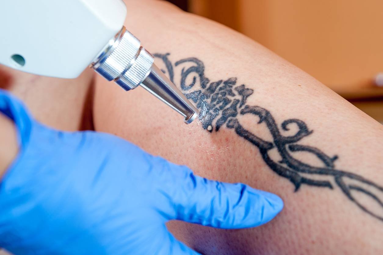 procedimento seduta rimozione tatuaggio